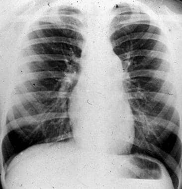 Valvar Pulmonary Stenosis. Posteroanterior chest r