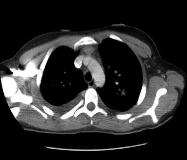 CT scan of the thorax (mediastinal windows) of a 1