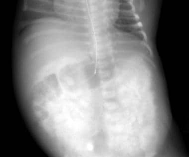 Excretory urogram shows the typical mottled (spong