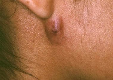 Dermatologic Manifestations of Coccidioidomycosis: Overview, Patient  History, Physical Examination