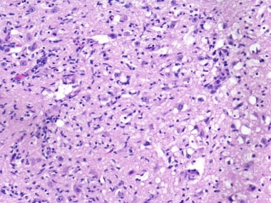 Early Wernicke encephalopathy, with prominent capi