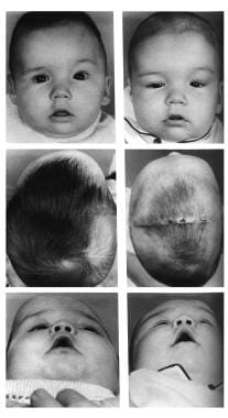 Congenital, synostoses. Plagiocephaly due to left 