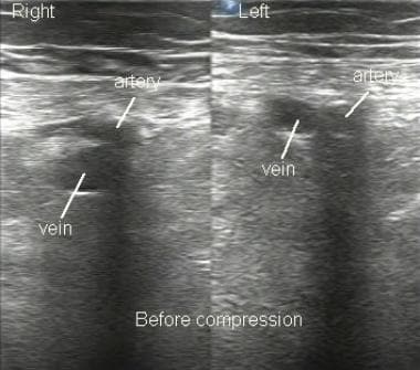 Ultrasonographic image of femoral vessels without 