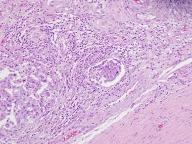 Pathology of embryonal carcinoma. Low-magnificatio