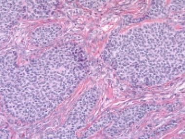 Granulosa cell tumor, insular pattern (hematoxylin