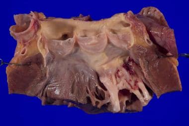 Pathology of Sudden Natural Death. A 53-year-old w