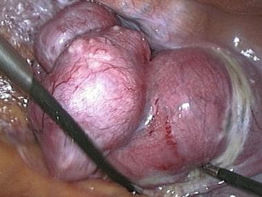 Transvaginal extraction of the uterus in total lap