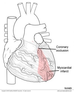 Myocardial infarction and regional affected cardia