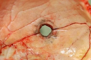 Internal beveling of a contact entrance wound of t