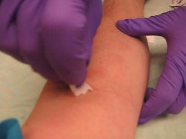 Application of antiseptic solution for IV cannulat