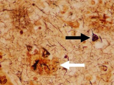 Dementia pathology. Bielschowsky silver staining o