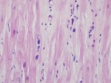 restrictive cardiomyopathy histology