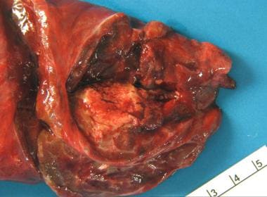 Zygomycosis: Lung with a large necrotic nodule. 
