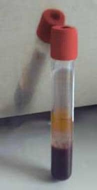 Red vacutainer tube. 