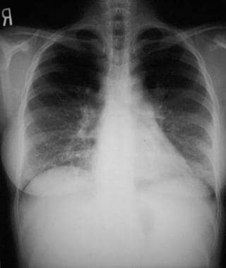Chest radiograph of lymphocytic interstitial pneum