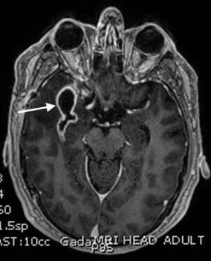 MRI of right temporal lobe abscess. This T1 contra