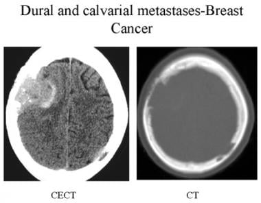 Contrast-enhanced CT and bone CT of a patient with
