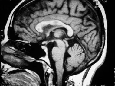 Sagittal T1-weighted MRI depicts multiple hypointe