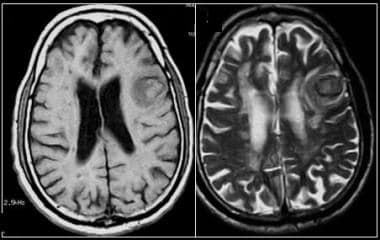 MR images show an acute hematoma in the left front
