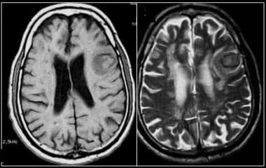 T1 weighted mri blood