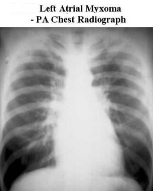 Posteroanterior (PA) chest radiograph shows pulmon