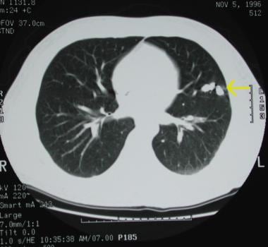 Pulmonary arteriovenous malformation in the left u