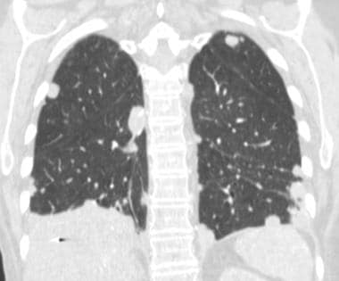 Coronal CT scan in a 62-year-old woman with malign