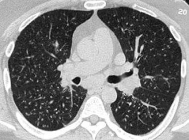 Computed tomography scan, pulmonary window, from a