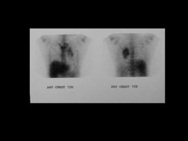 镓-67（67ga）扫描显示胸腔内喉咙