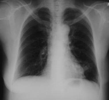 Solitary pulmonary nodule. Pulmonary arteriovenous