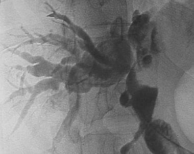 Cholangiogram demonstrates disease in extrahepatic