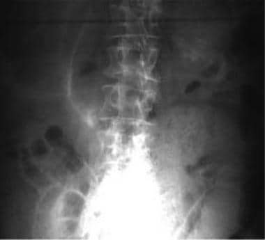 This supine abdominal radiograph shows a pneumoper