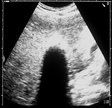 On this sonogram in the same patient, a calcified 