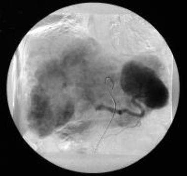 Celiac-axis angiography (venous phase) of a patien