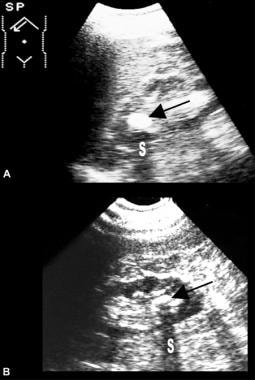 Longitudinal sonogram through left kidney shows th