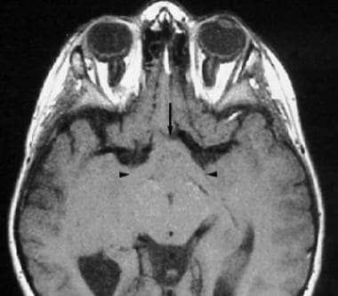Axial noncontrast T1-weighted MRI in a 46-year-old