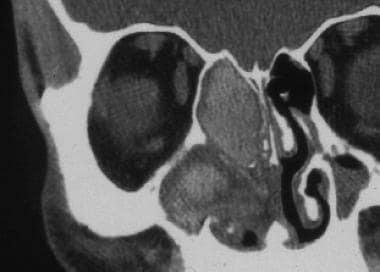 真菌性鼻窦炎。软组织占据右侧区域