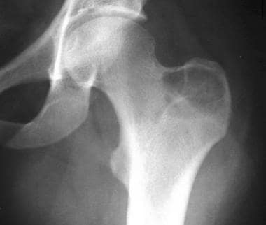Plain radiograph of the greater trochanter in a 24