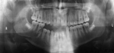 Panoramic radiographic image of a fracture of the 