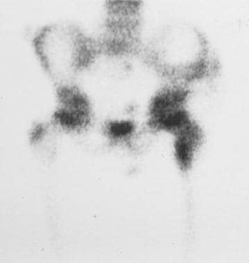 Radionuclide bone scan of the hip in an 8-year-old