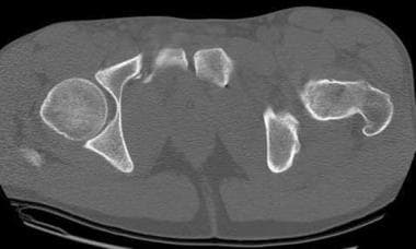 Vertical shear injury as seen on a pelvic CT scan.