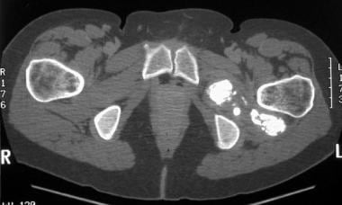 Computed tomography scan of the hip in a patient w