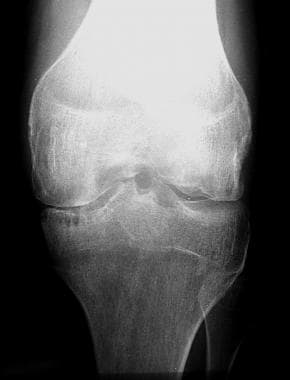 Radiograph of the leg in a patient with hemophilia