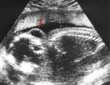 Image result for cystic hygroma ultrasound