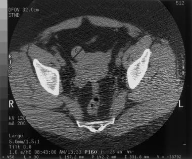 CT scan shows a subserosal, 2.3- to 2.5-cm, right 