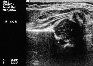 Real-time coronal sonogram of the hip shows calcul