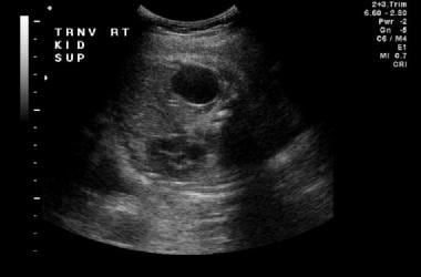 A coronal prenatal sonogram of the retroperitoneum