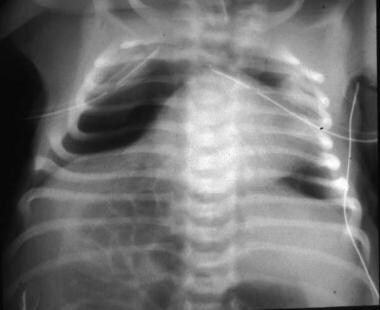 注意肺容积小，肺动脉狭窄