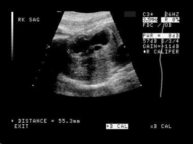 Ureteropelvic Junction Obstruction Ultrasound