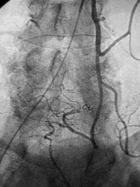 Postembolization arteriogram in a patient with acu